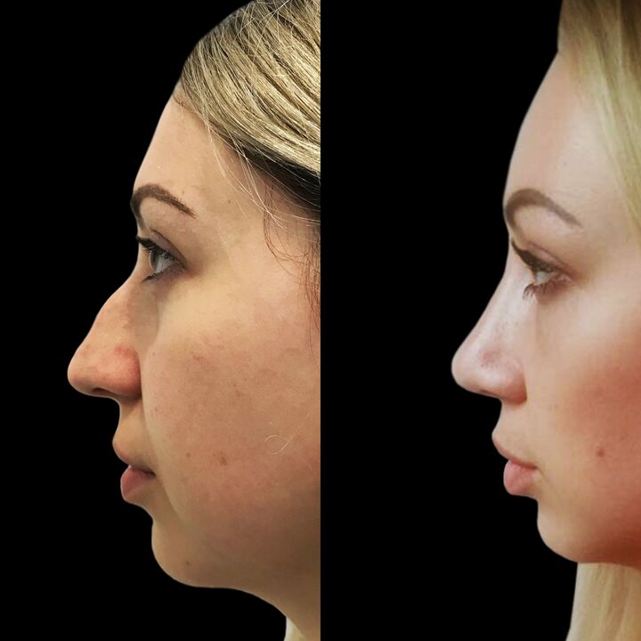 Rinoplastika