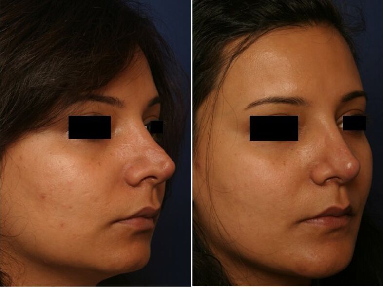 výsledek plastické chirurgie