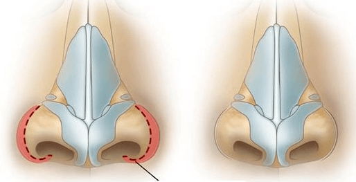 Redukce nosních dírek