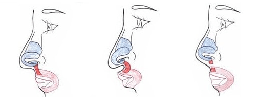 Zkrácení části nosního svalu