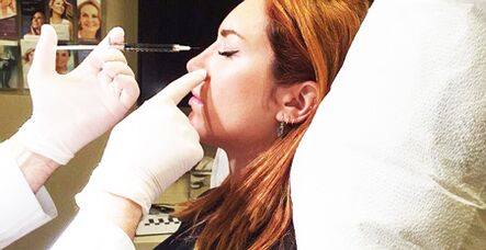 Zákrok rinoplastiky s použitím výplní