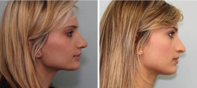 Výsledky rhinoplastiky před a po