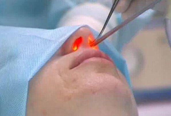 laserová rhinoplastika nosu