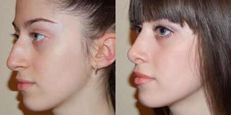 fotografie před a po rhinoplastice nosu