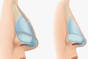 nos před a po rinoplastice