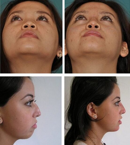 fotografie před a po rhinoplastice bez chirurgického zákroku