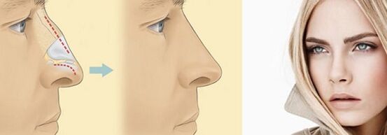 korekce tvaru nosu nechirurgickou rhinoplastikou