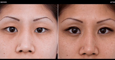 před a po operaci očí