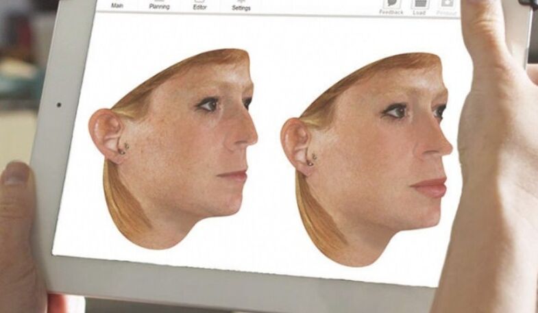Metoda počítačového modelování nosu před rhinoplastikou