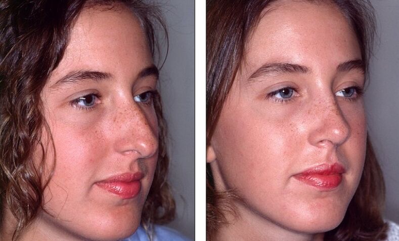 Nos před a po neúspěšné rinoplastice