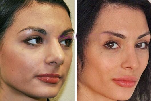 nos před a po plastické operaci