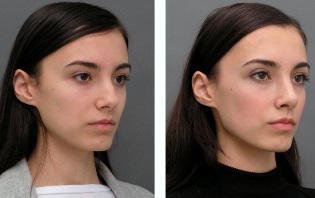 Dívka před a po operace nosu