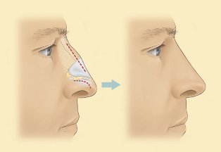 Jak probíhá šetřící operace očních víček